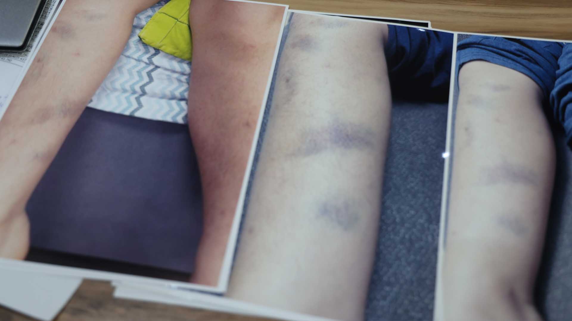 Diyarbakır’da Özel Okulda Darp Iddiası, 8 Yaşındaki Çocuk Için Suç Duyurusu