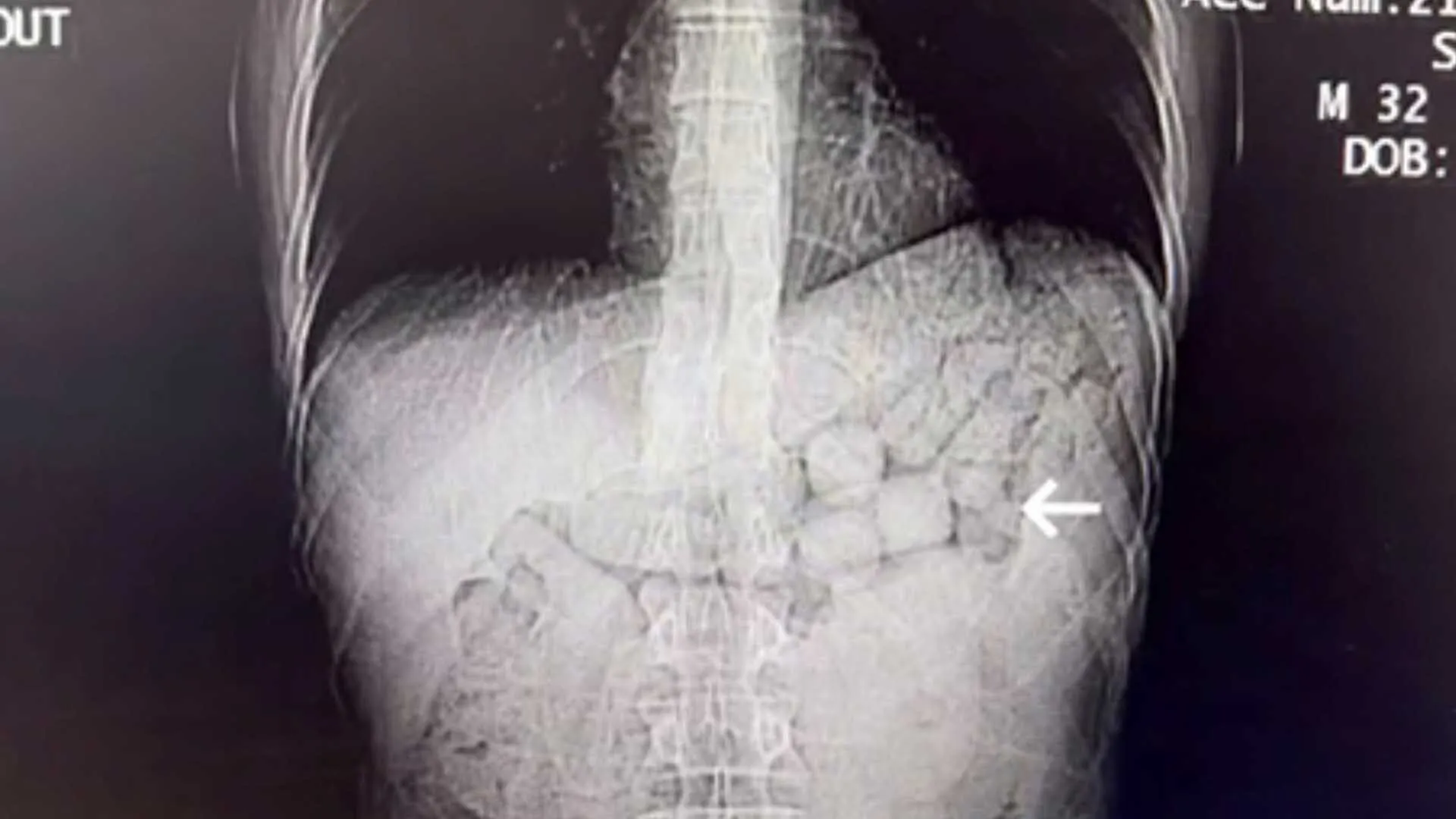 Diyarbakirda Midelerinde Tasidiklari 807 Gram Uyusturucu Ile Yakalanan 2 Kisi Tutuklandi 2