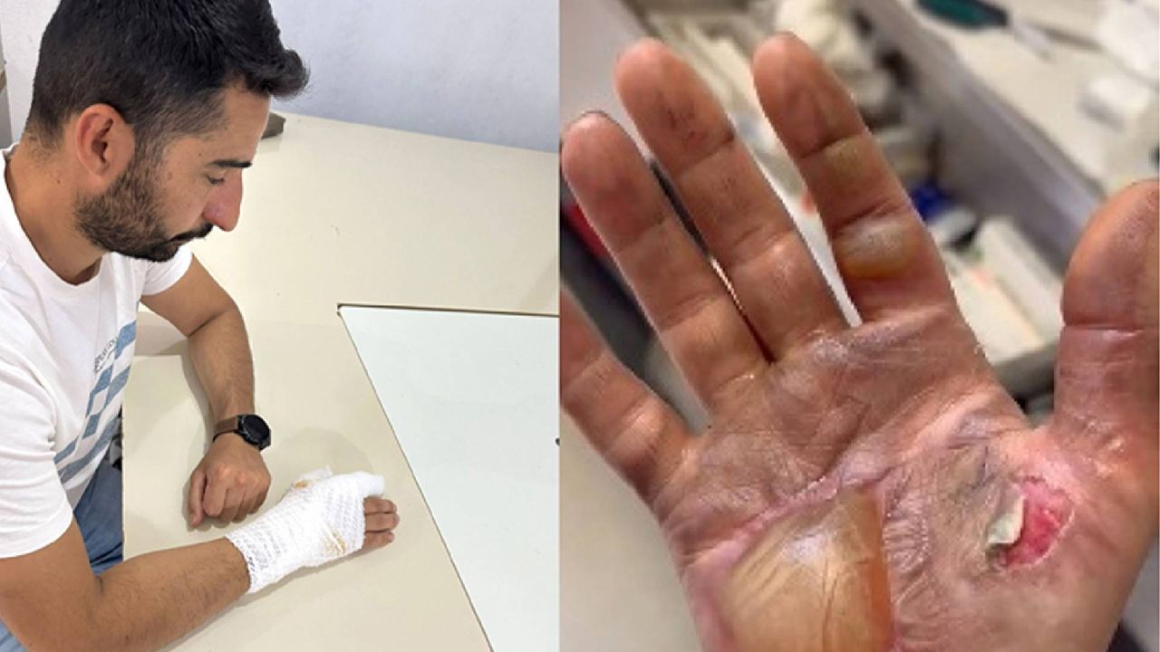 Tamir Sırasında Telefon Bataryası Patladı