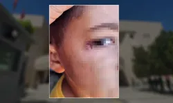 Temizlik Görevlisi, 7 Yaşındaki Öğrencinin Yüzünde Sigara Söndürdü