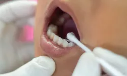 Florür tedavisinde büyük yanlış: bu hatalar dişlere ve sağlığa zarar veriyor!