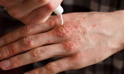 Soğuk Havada Cilt Kuruluğuna Karşı 10 Altın Tavsiye