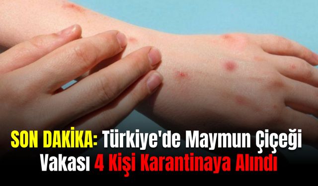 SON DAKİKA: Türkiye'de 4 Kişi Maymun Çiçeği Şüphesiyle Karantinaya Alındı