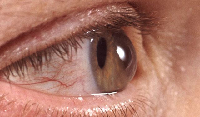 Gözleri Sık Ovuşturmak Körlüğe Kadar Götürebilir