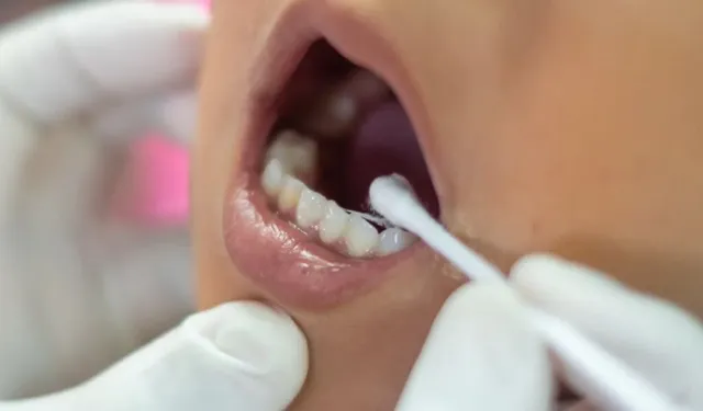 Florür tedavisinde büyük yanlış: bu hatalar dişlere ve sağlığa zarar veriyor!